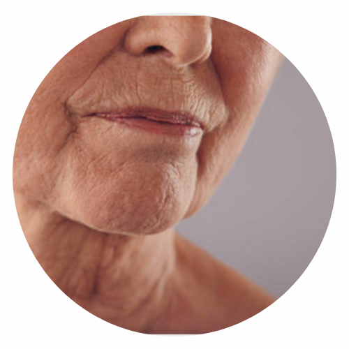 Nasolabial folds & marionette lines