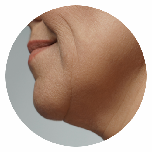 Chin reshaping