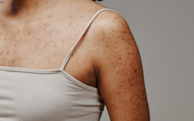Treating Hyperpigmentation from the Inside Out: Our Holistic Approach